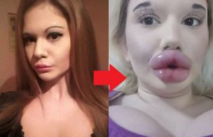 21-jarige Andrea gooit nóg meer fillers in haar lippen: ‘Zo ben ik mooier!’ Andrea