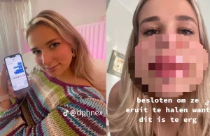 Celine blijkt allergisch voor lip fillers en moet nu een paar weken zó rondlopen: Lip Fillers