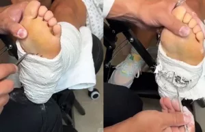 Je grootste nachtmerrie: Er kriebelt iets tussen het gips en de voet van deze dame! Nachtmerrie