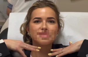 19-jarige Jade Anna laat lippen opspuiten: ‘Wilde het natuurlijk houden…’ Jade Anna