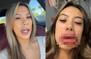 Meisje compleet in tranen na lipvergroting: ‘Dit is véél te groot!’ Lipvergroting