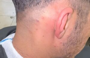 Kapper ontdekt enorme ingegroeide haar die al drie jaar doorgroeit onder huid van klant! Kapper