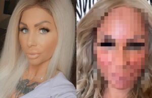 Samantha de Jong heeft een CO2-gezichtsbehandeling uitgeprobeerd en heeft plots een nieuw gezicht! Samantha de Jong